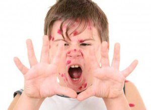 Vărsatul de vânt se poate …