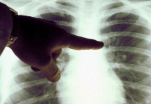 Problema TBC în România, scăpată de sub control