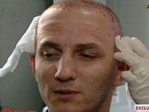 Vezi cum arată Mihai Trăistariu la o lună după ce şi-a făcut implant de păr