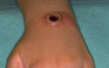 Alertă medicală! Un botoșănean, suspectat …