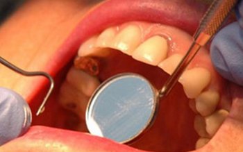 Totul despre cariile dentare. Cât …