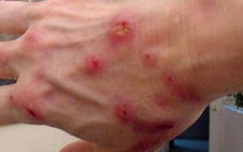 Boala cu o mie de …