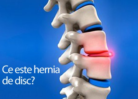 Semne că ai hernie de disc