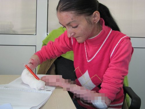 Apel umanitar: Oana suferă de o maladie rară care îi macină pielea și oasele