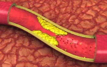 Descoperă semnele că ai arterele …