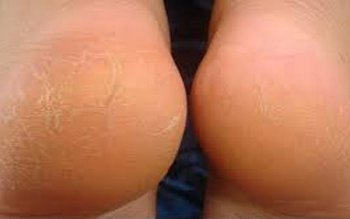 Scapă de călcâiele crăpate cu …