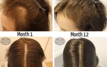 Îi cădea părul, așa că …