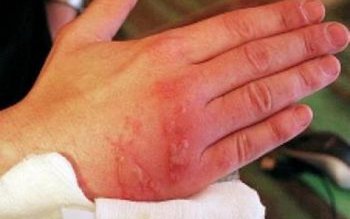 Cum poți trata cicatricile provocate …