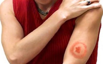 Care sunt simtomele bolii Lyme …