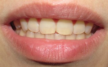 Detartrajul: când se recomandă și …