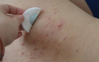 Îţi apar coşuri pe spate? …