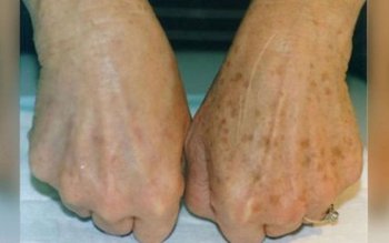 Ai astfel de pete pe …