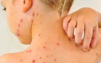 RUJEOLA face ravagii în România: …