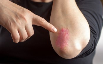 Psoriazisul este mai frecvent decât …