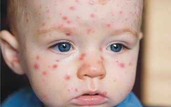 Cât timp este contagioasă varicela