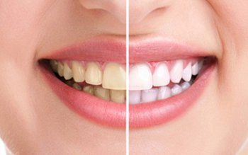 Cum putem să prevenim acumularea …