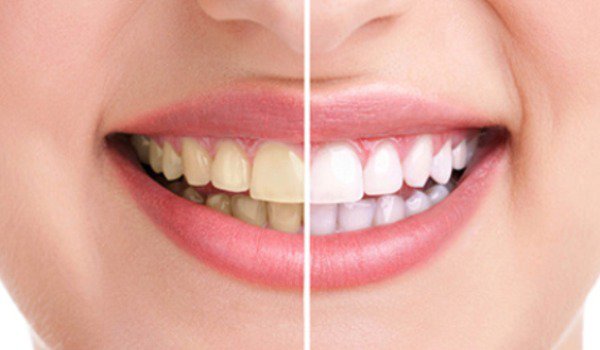 Cum putem să prevenim acumularea tartrului dentar?