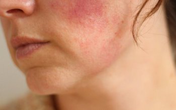 Cum putem controla cuperoza