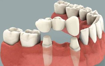 Ce opțiuni avem pentru înlocuirea …