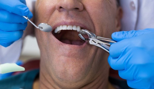 Un român a murit în Italia, după ce şi-a scos singur doi dinţi. Nu avea bani să meargă la dentist
