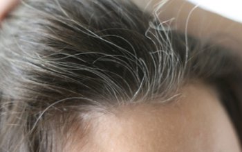 Cauze ale albirii părului de …