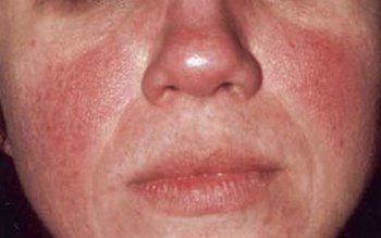 Cum putem trata cuperoza cu …