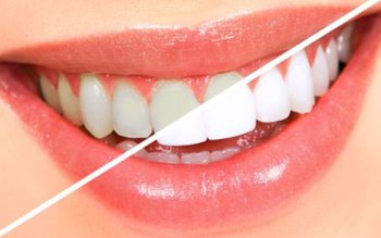 Cum să-ți albești dinții în …