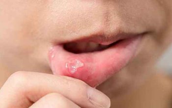 Când apar aftele bucale