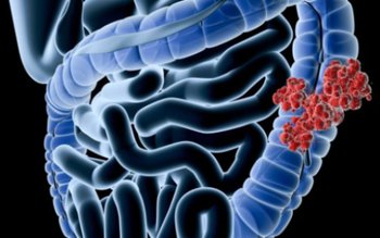 Simptomele cancerului de colon pe …