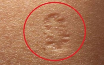 Ai această cicatrice pe brațul …