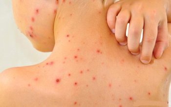 Virusul rujeolic sterge „memoria” sistemului …