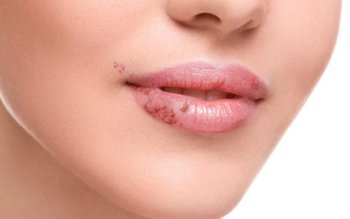 Ulcer bucal și afte? Remediile …