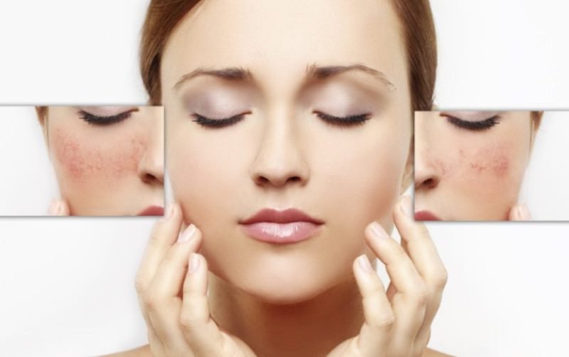 Roșeața pe față poate fi, un semn al diferitelor boli