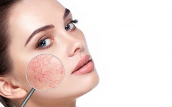 Roșeață pe față: care sunt …