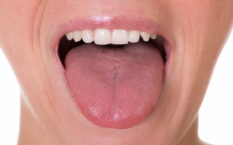 Orice schimbare a aspectului limbii poate ajuta la diagnosticarea unor boli