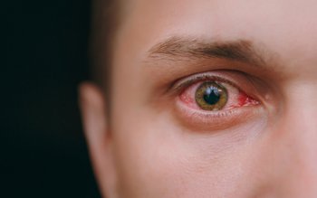 Cum prevenim conjunctivita bacteriană sau …