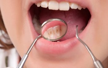 Retețe naturale de oprire a …