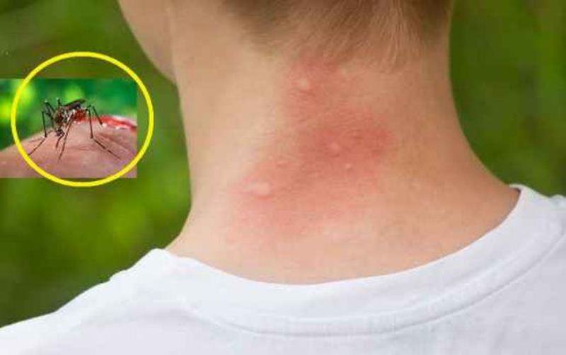 Cum putem trata mușcăturile de țânțari