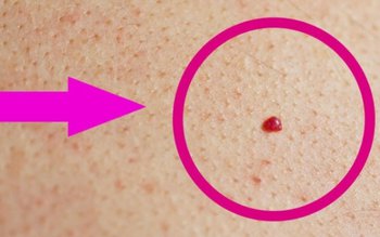 De ce apar alunițe roșii …