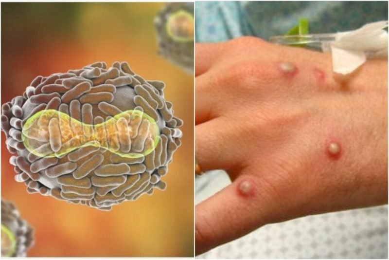 Tot mai multe țări raportează noi cazuri de infecție cu variola maimuței