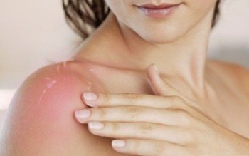 Remedii naturale rapide pentru arsuri …