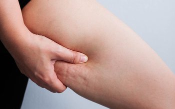 Celulita pe înțelesul tuturor