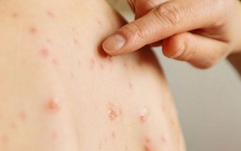 Ministerul Sănătății a declarat epidemie …