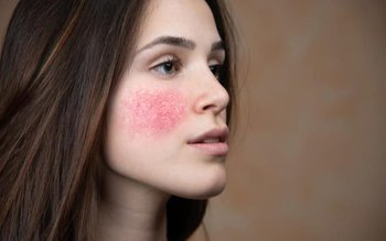 Roșeață pe față: vezi care …