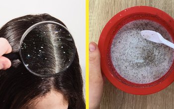 Cum poți scăpa de mătreață …