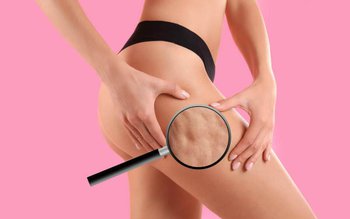 Luptă cu celulita, în mod …