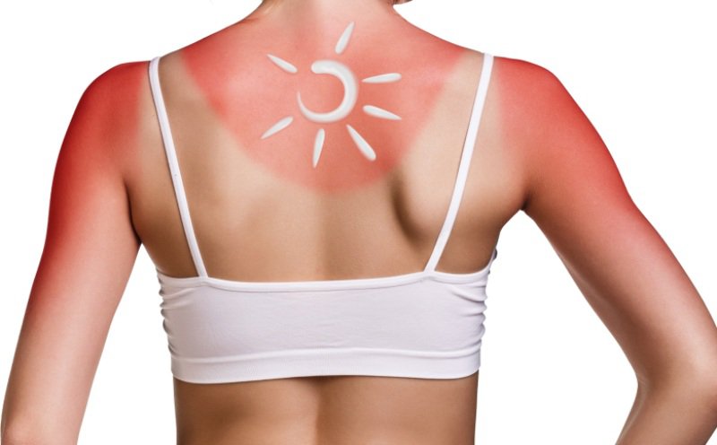 Cum putem să ne bronzăm fără arsuri solare