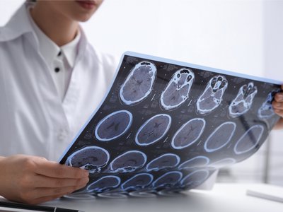 Scleroza multiplă: Simptome care anunţă …