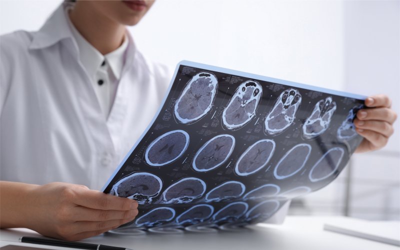 Scleroza multiplă: Simptome care anunţă instalarea bolii