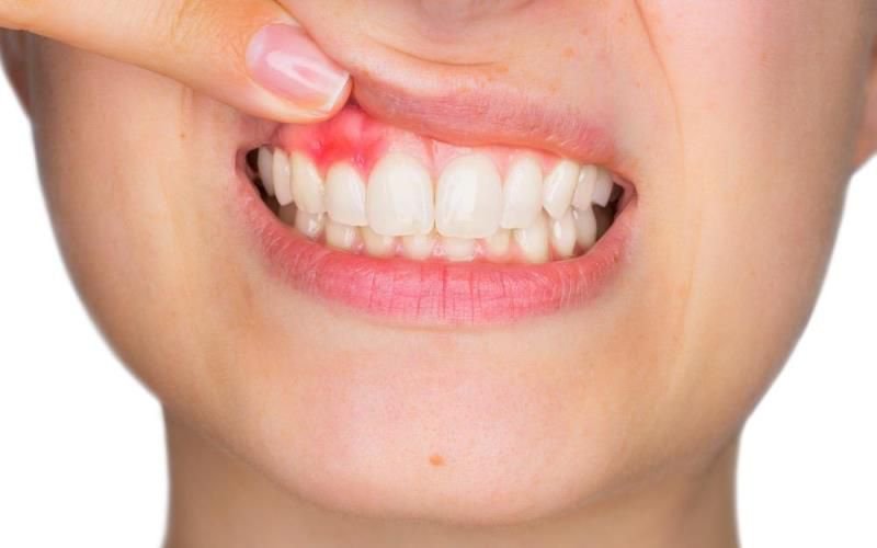Rețete naturale de oprire a sângerărilor gingivale